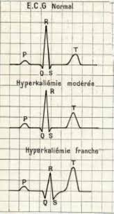 3 tracés d'ECG normal, avec hyperkaliémie modérée et franche